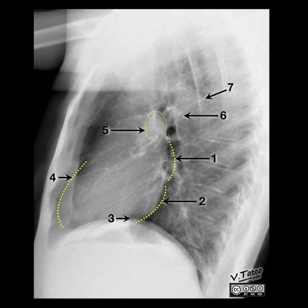 <p>1: Left atrium<br>2: Left ventricle<br>3: IVC<br>4: Right ventricle<br>5: Right pulmonary artery<br>6: Left pulmonary artery<br>7: Aorta</p>