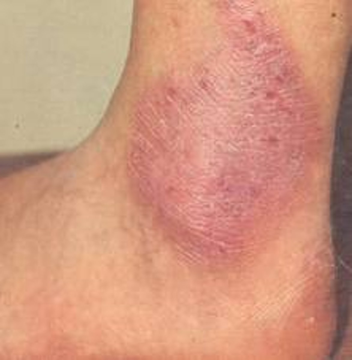 <p>- benign epithelial thickening &amp; hyperkeratosis from chronic irritation (from use of perfumed pads, or infection)itching, raised white lesions</p><p>- biopsy</p><p>- Tx: vulvular hygiene, sitz baths, lubricants, oral antihistamine, topical steroid</p>