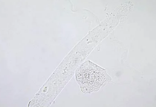 <p>Identify this cast. What is the most appropriate interpretation of this finding?</p>