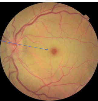 <ul><li><p>Cherry red spot</p></li><li><p>90 minutes to unlock → Permanent, irreversible VA loss</p></li></ul><p></p>