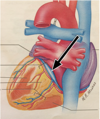 <p>enlarged vessel on the posterior aspect of the heart that empties blood into the right atrium.</p>