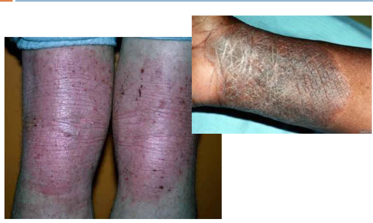 <p>__________: thickening or roughening of the skin (leather bark like)</p>