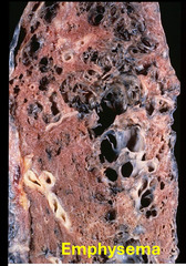<p>Emphysema is highly associated to smoking. The enlarged openings in the lung are mainly due to</p>