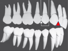 <p>Where is the largest incisal embrasure located in the mouth?</p>