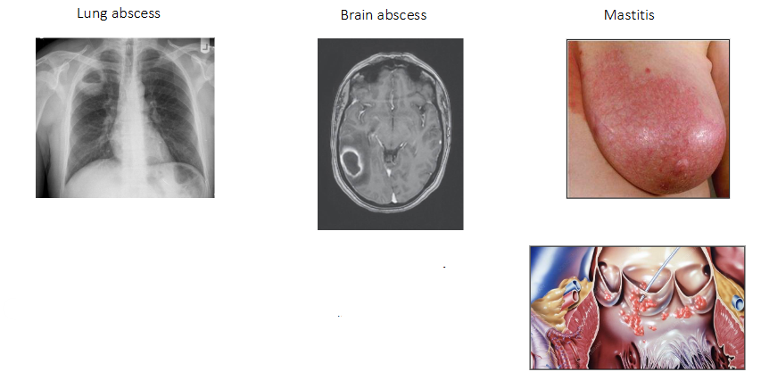<p>- Lung abscess</p><p>- Brain abscess (means swelling due to pus)</p><p>- Mastitis</p><p>.</p><p>- Disseminated infection - bacteraemia</p><p>- S. aureus circulating in the bloodstream</p><p>- May progress to infection of a heart valve: endocarditis</p>