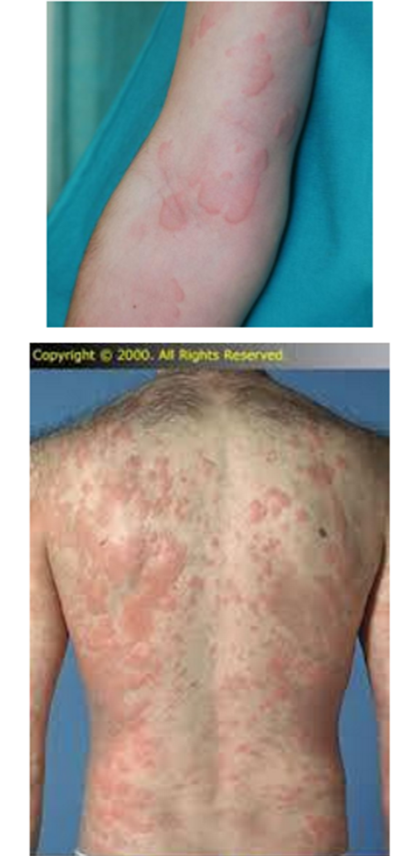 <p>What kind of lesion is this?</p>