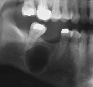 <p>Radiographic Shape: having on compartment or unit that is well defined or outlined </p>