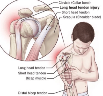 <p>when the long head of the biceps tendon partially slips out of the bicipital groove in the front of the shoulder from repetive over head use (throwing or lifting)</p>