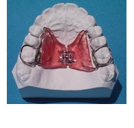 <p>which type of palatal expander:</p><p>◦ Tooth and tissue borne</p><p>◦ Can split the midpalatal suture</p><p>◦ True boney expansion</p><p>◦ Less dental tipping due to tissue support</p><p>◦ Difficulty with oral hygiene under palatal acrylic</p>