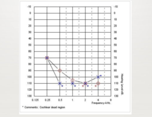 <p>what type of audiogram</p>