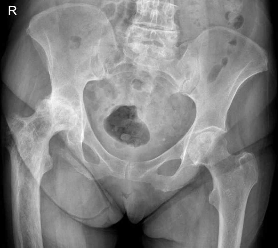 <p>Sclerotic </p>