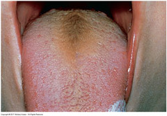 <p>early stage before black hairy tongue. tongue appears brown. Can be from coffee, tea, mild tobacco use, etc.</p>