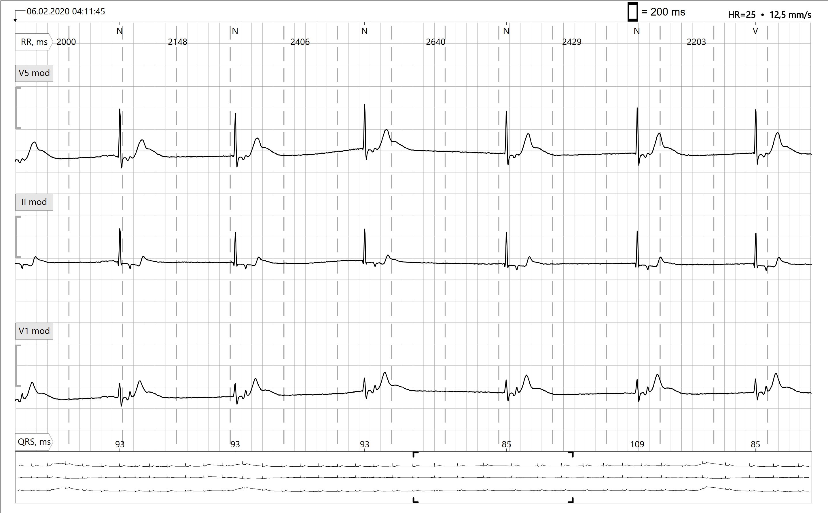 <p>Rate: 40-60 bpm</p><p>Regularity: regular</p><p>P waves are either absent, in QRS, after QRS, or inverted before QRS</p>
