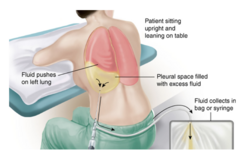 <p>surgical puncture to remove fluid from the pleural space</p><p>relieves symptoms from the fluid but will not treat the underlying cause</p>