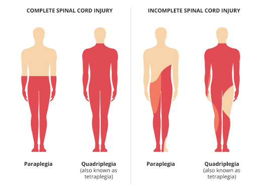 <ul><li><p><u>Tetraplegia/quadriplegia:</u> <strong>C1–T1</strong> → affects arms, trunk, legs</p></li><li><p><u>Paraplegia</u><strong>: Below T1</strong> → affects trunk, legs</p></li></ul><p></p>
