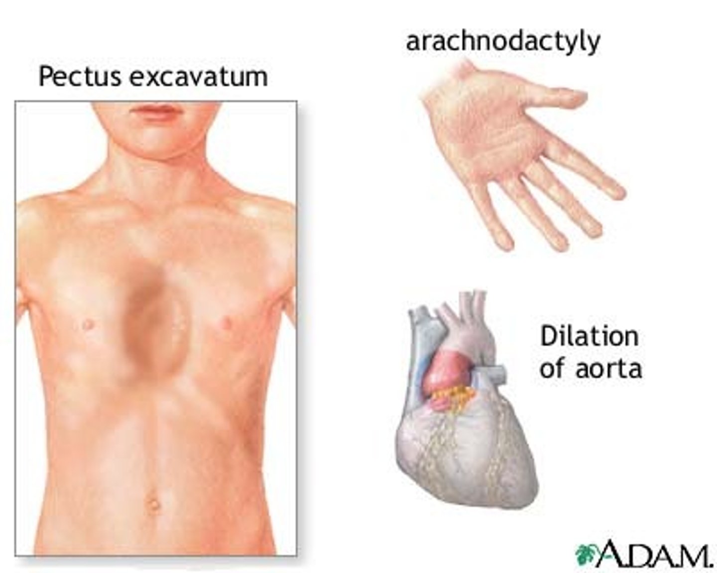 <p>autosomal dominant</p>