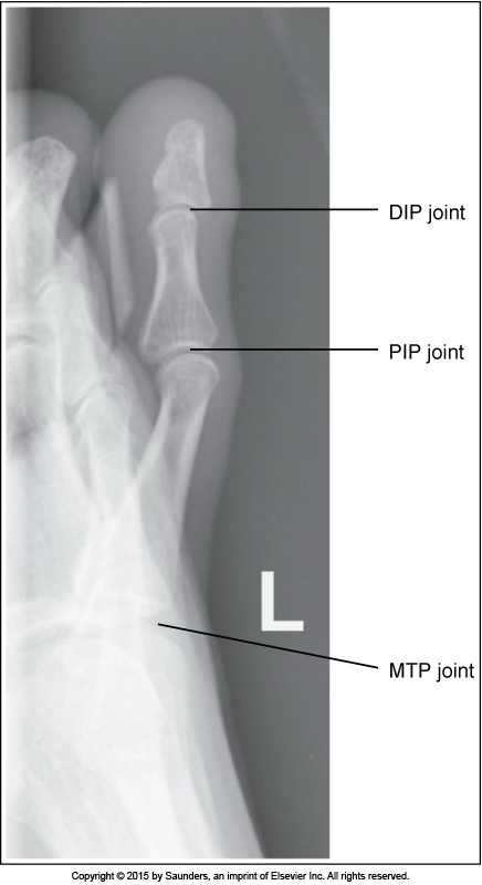 <p>second toe lateral</p>