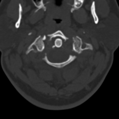 <p>Burst fracture at C1</p><p>Bilateral anterior/posterior fractures of the ring of C1</p><p>Most commonly associated with diving into shallow water</p>