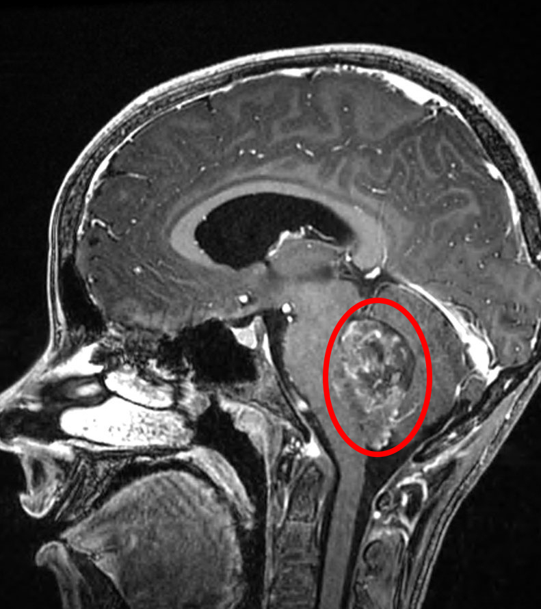 <ul><li><p>posterior fossa of brain</p></li></ul><p></p>