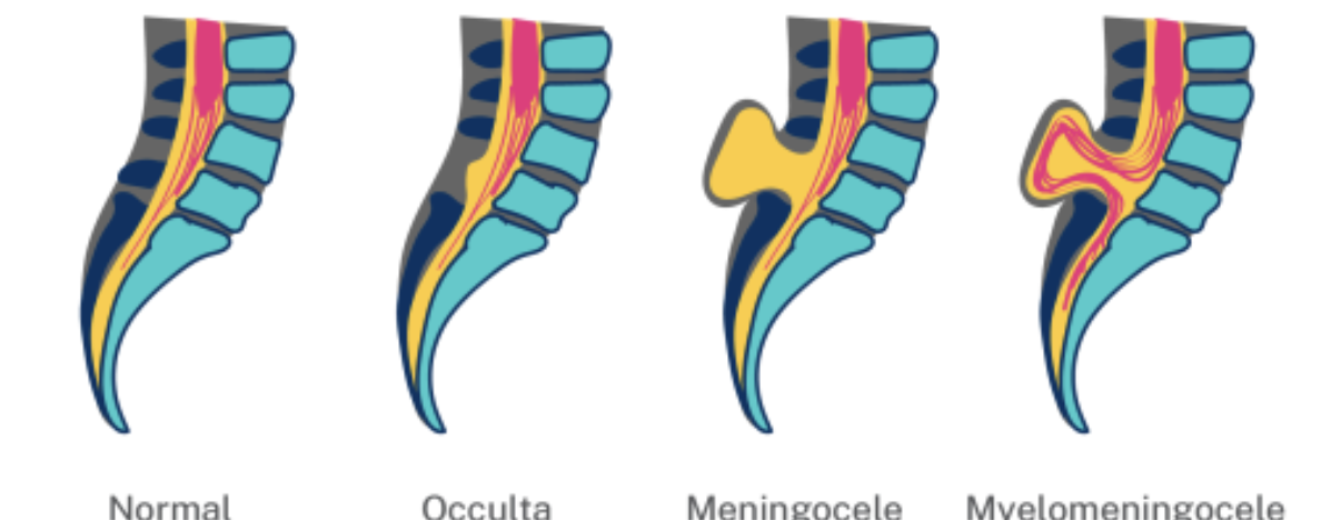 <p>Most severe. Protrsion of fluid-filled sac containing parts of the spinal cord, CSF, and meninges.</p>