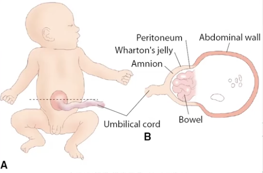 <ul><li><p>during 8-12th weeks of development, fetal bowel normally migrates into umbilical cord from abdominal cavity</p><ul><li><p><span style="color: red;">bowl-containing omphalocele</span> occurs when <span style="color: red;">bowel loops fail to return to abdomen</span></p></li></ul></li><li><p>intra-abdominal structures herniate into the base of the umbilical cord</p><ul><li><p>herniation is <span style="color: yellow;">covered by membrane</span> that consists of amnion and peritoneum</p></li><li><p><span style="color: red;">cord goes through the omphalocele</span></p></li></ul></li><li><p><span style="color: red;">AFP is within normal limits</span> (may be slightly elevated)</p></li></ul><p></p>