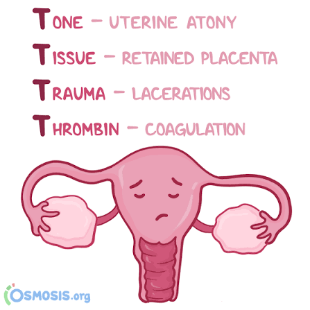 <p>Early Postpartum Hemorrhage Causes: 4 T’s</p>