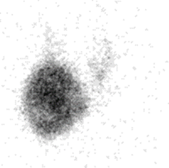 <p>Hyperfunctioning thyroid nodule that takes up the radioactive iodine in a nuclear medicine scan.</p><p>- least likely to be malignant.</p><p>- patient probably has elevated T4</p>