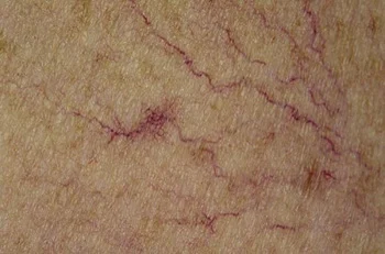 <p>Telangiectasis (vascular lesion)</p>