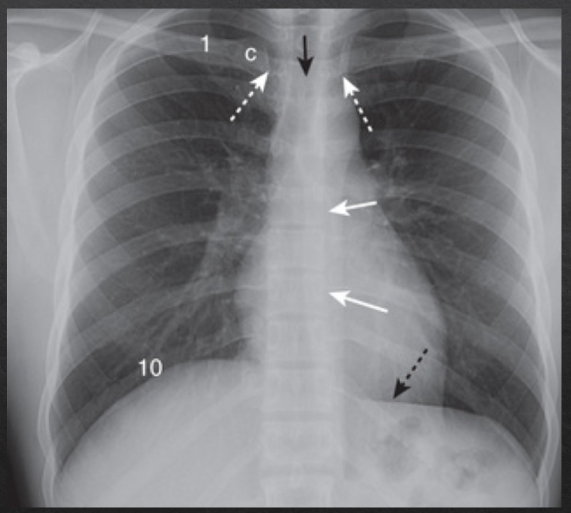 <ul><li><p>degree to which xrays have passed through the body </p></li><li><p>adequate penetration:</p><ul><li><p>outline of the thoracic spine visible through heart </p></li></ul></li><li><p>inadequate penetration</p><ul><li><p>can mimic or hide disease </p></li></ul></li></ul><p></p>