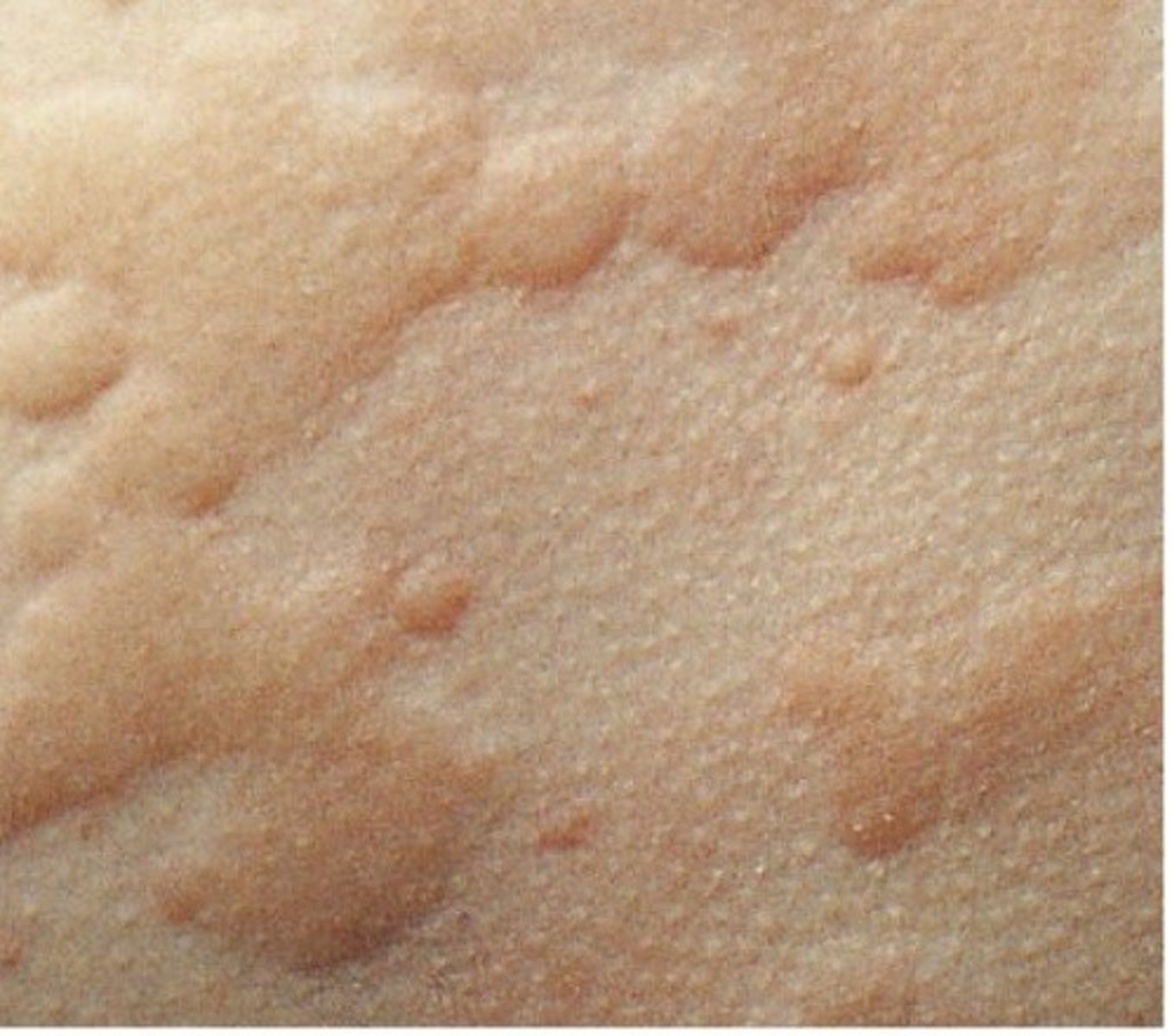 <p>urticaria</p><p>-described as a wheal</p><p>-lasts <24h</p><p>-circumscribed, raised lesion consisting of dermal edema</p><p>-comes and goes</p><p>-itchy</p><p>-changes shape</p>