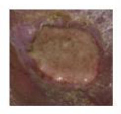 <p>Slough (note: precursor to scabbing over; similar to the appearance of skin when getting out of a bath)</p>