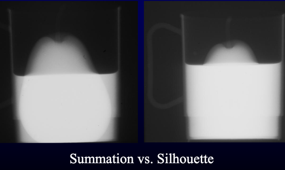 <ul><li><p><strong>Silhouette =</strong> Similar opacity + direct contact → <span style="color: red;"><strong><mark data-color="red" style="background-color: red; color: inherit;">Loss of visible border</mark></strong></span></p><ul><li><p><span style="color: green;"><strong>EX: Pear inside the water</strong></span></p></li></ul></li><li><p><strong>Summation</strong> <strong>= </strong>Superimposed structures → <span style="color: blue;"><strong><mark data-color="blue" style="background-color: blue; color: inherit;">Increased overall opacity</mark></strong></span></p><ul><li><p><span style="color: green;"><strong>EX: Pear outside the cup, overlapping it in your view</strong></span></p></li></ul></li></ul><p></p>