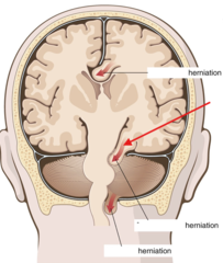 <p>What kind of herniation is this?</p>