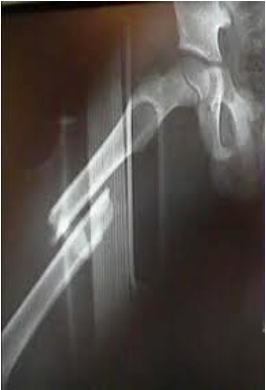 <p>One at right angles to the axis of the bone</p>