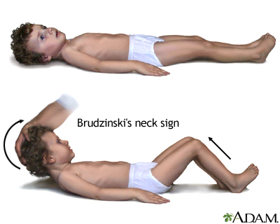 <p>hip &amp; knee movement when neck is flexed (Brudzinski’s neck sign) is a symptom of what?</p>