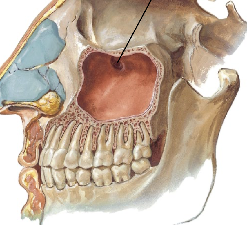 <p>Which of the paranasal sinuses is the largest? Describe its location relative to other features. What is the clinical significance of the high ostium of the maxillary sinus?</p>
