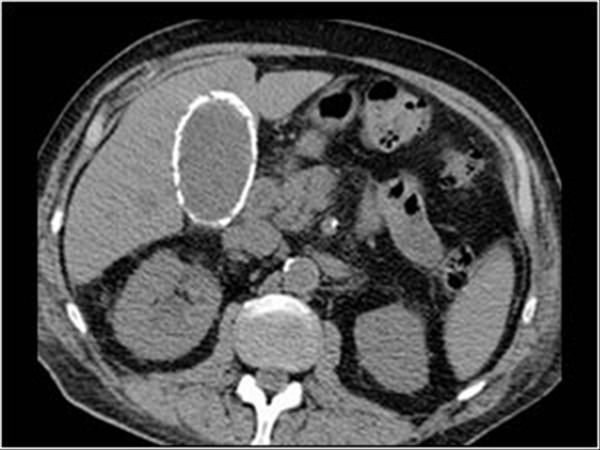<p>Hyperechoic along gallbladder wall with some shadowing. This was a porcelain gallbadder. Porselensgalleblære. Can be difficult to differentiate from emfysematous gallbladder. No WES-triad so large stone unlikely. <br>Almost every pt with porcelain gallbladder have stones.</p>
