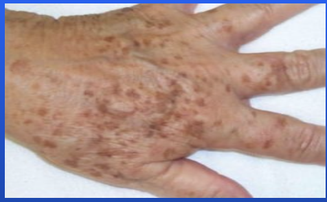<p>Brown skin spots caused by sun exposure.</p>