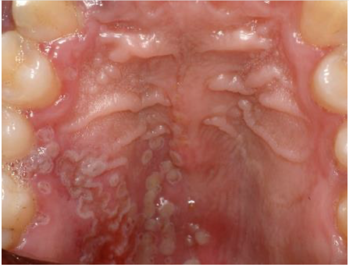 <p>what is this lesion</p>