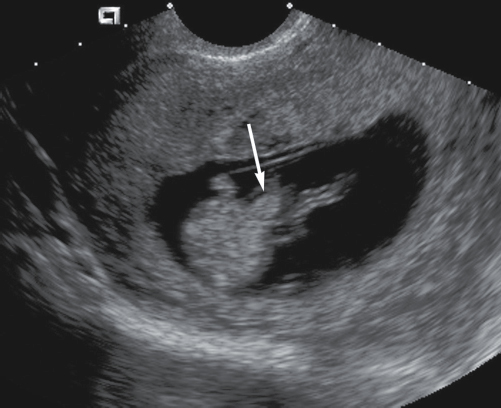 <p>5. What does the arrow in the <strong>11-week</strong> fetus in Figure 23-29 indicate?</p><p></p><p>a. Omphalocele</p><p>b. Physiologic bowel herniation</p><p>c. Gastroschisis</p><p>d. Ectopia cordis</p>