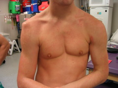<p>Arm held abducted and externally rotated.</p><p>Loss of normal rounded deltoid contour ("squared-off" appearance).</p><p>Humeral head palpable anteriorly.</p><p>Apprehension test positive (patient resists abduction/external rotation).</p>