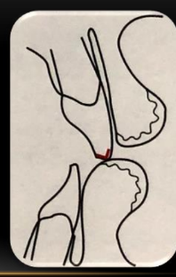 <p>-refine incisal edge position</p><p>-use F and V sounds</p><p>-incisal edge should contact the inner dry-wet line</p><p>-have patient phonate softly for this determination</p>