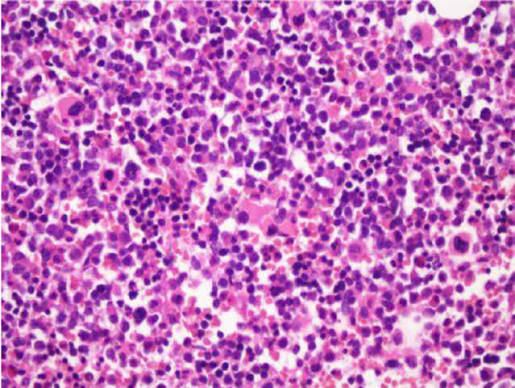 <p>How would the cells in this bone marrow smear be described as? (Consider, <em>are</em> <em>there</em> cells?)</p>