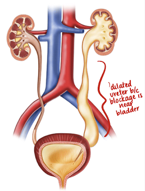 <ul><li><p>obstruction at the junction of the ureter and bladder</p></li><li><p>hydronephrosis occurs secondary to obstruction</p><ul><li><p>dilated ureter also forms: megaureter</p></li></ul></li><li><p>possibly from ectopic ureterocele within bladder causing obstruction of upper pole of kidney</p></li><li><p>males?females (biological)</p></li><li><p>may be unilateral or bilateral</p></li><li><p>definitive diagnosis is made with VCUG or ceVUS</p></li></ul><p></p>