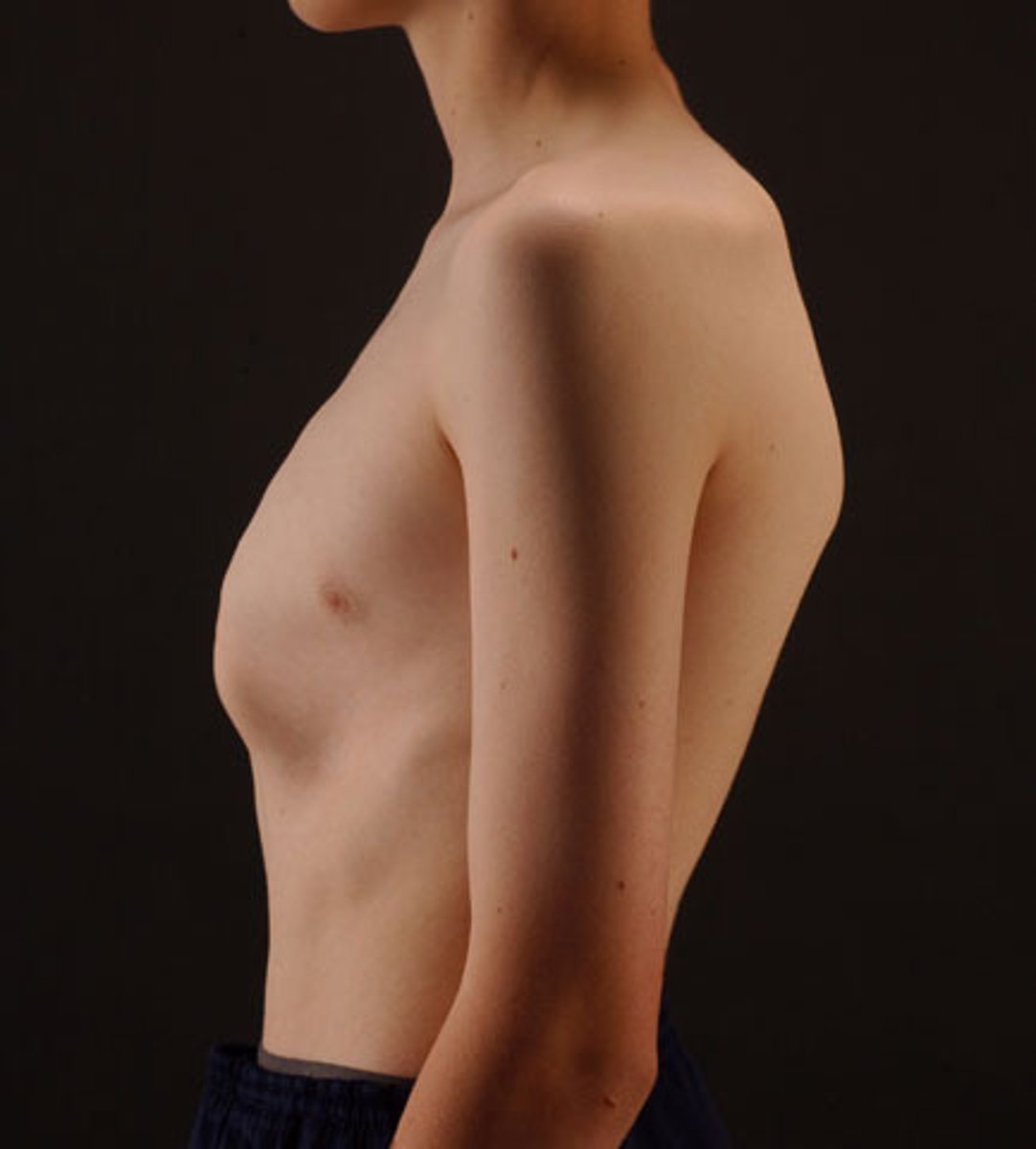 <p>forward protrusion of the sternum; pigeon chest; congenital</p>