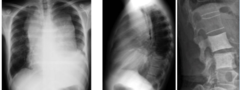 <p>What is this?</p><p>- 20-40 yo</p><p>- Pain after drinking alcohol</p><p>- Lower T/S + Upper L/S</p>