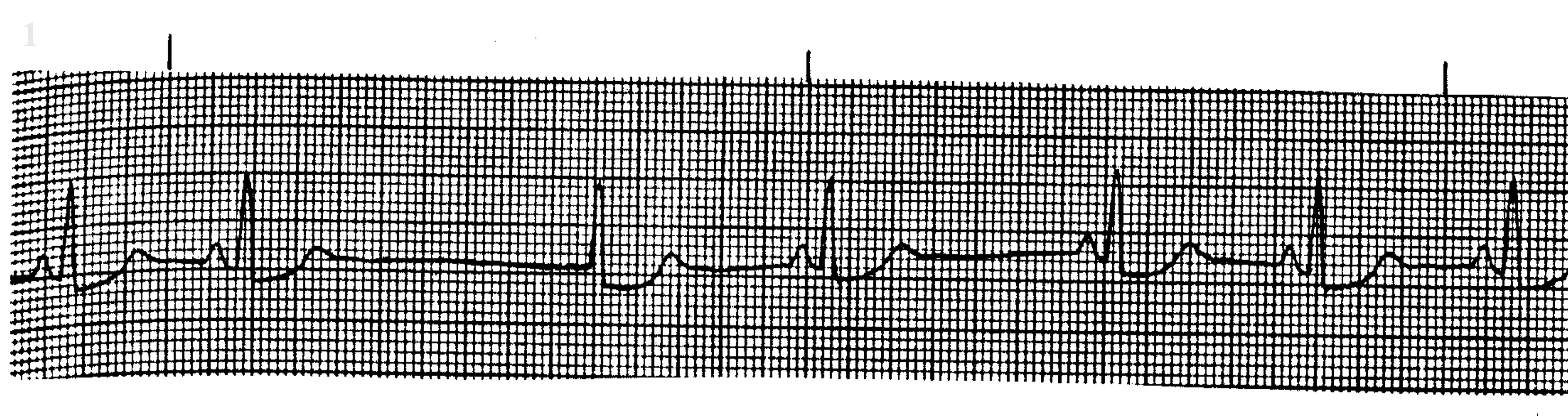 <p>What ECG is this? </p>