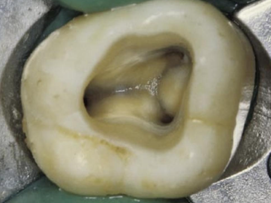 <p>What are dentinal maps?</p>