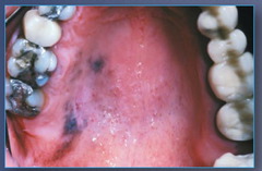 <p>Most common on the hard palate/maxillary mucosa; carries an extremely poor prognosis (5-yr survival 10-25%).</p>