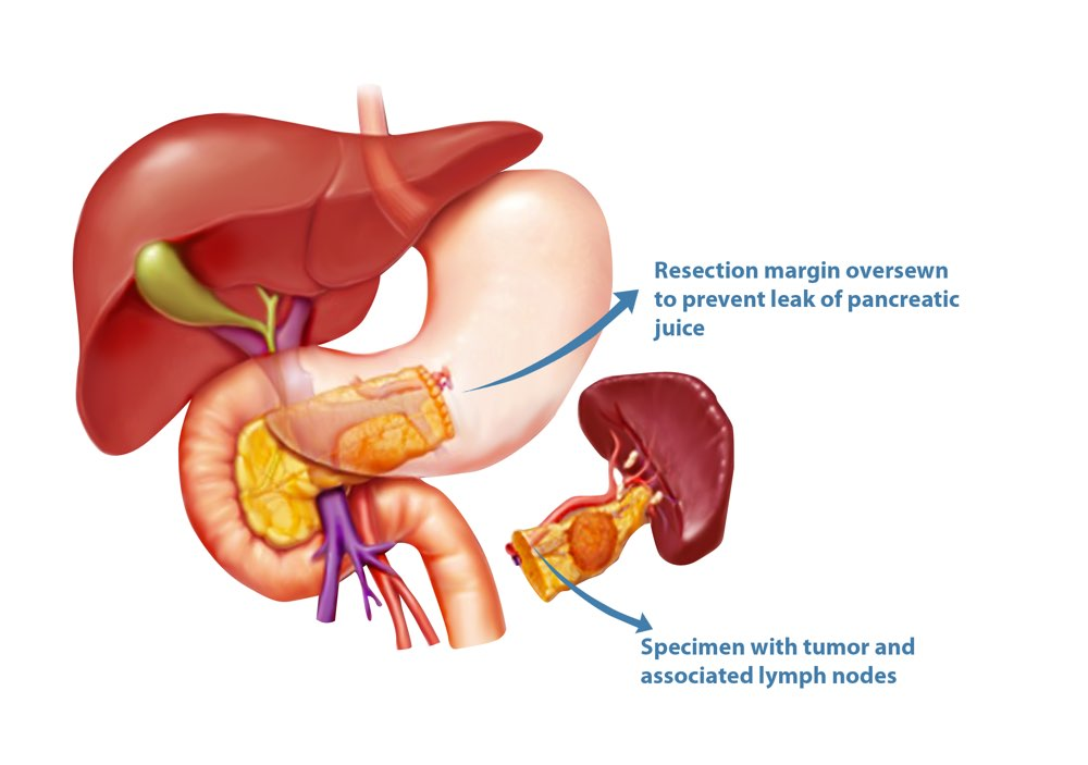 <p>distal pancreatectomy </p>